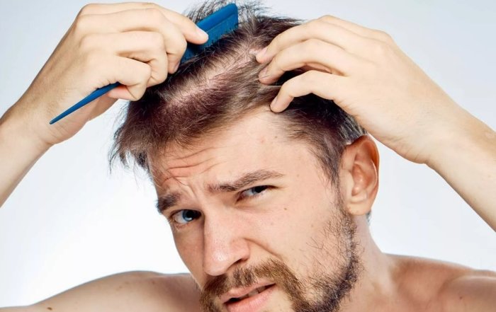 Hair Loss For Men