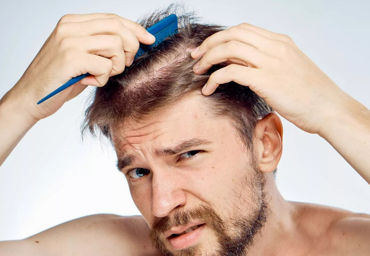 Hair Loss For Men