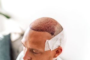 Best Hair Transplant 1