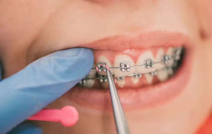 Braces