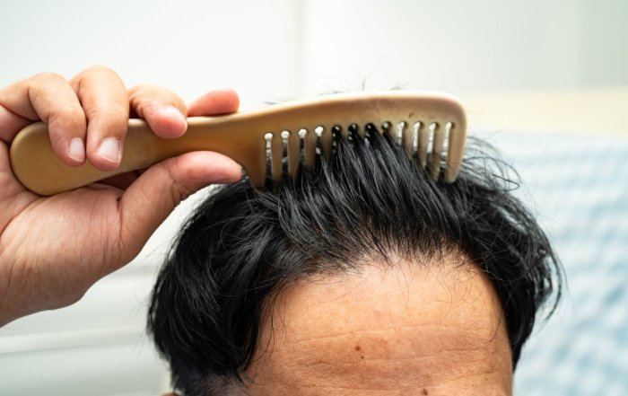 DHI hair Transplant 1