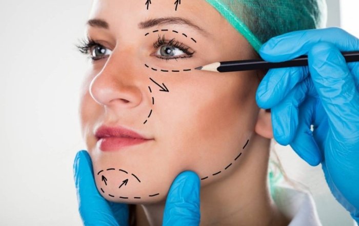 Facelift Surgery