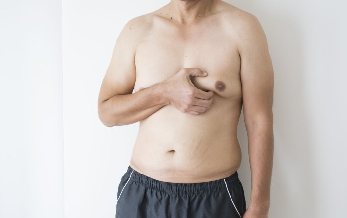 Gynecomastia