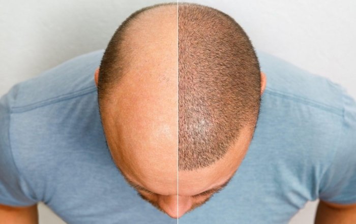Hair Transplant