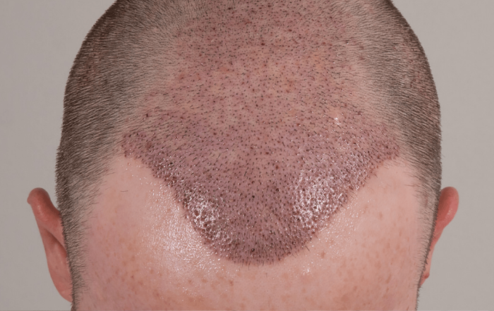 Hair Transplant