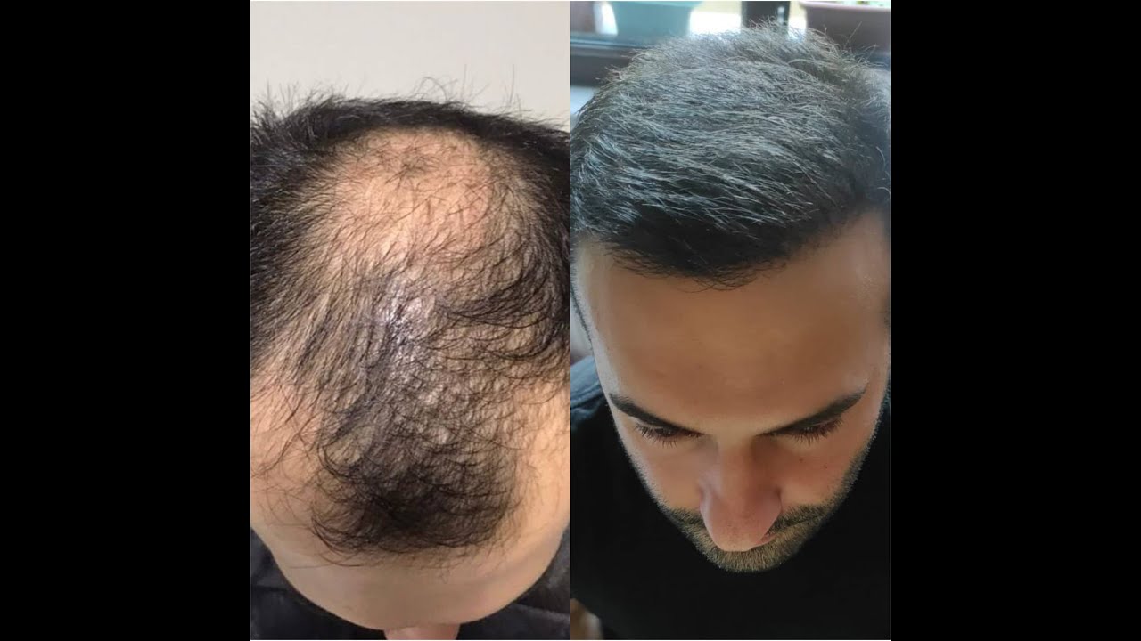 Hair Transplant Results
