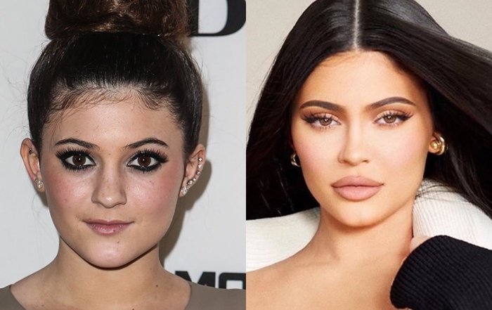 Kylie Jenner Before Surgery