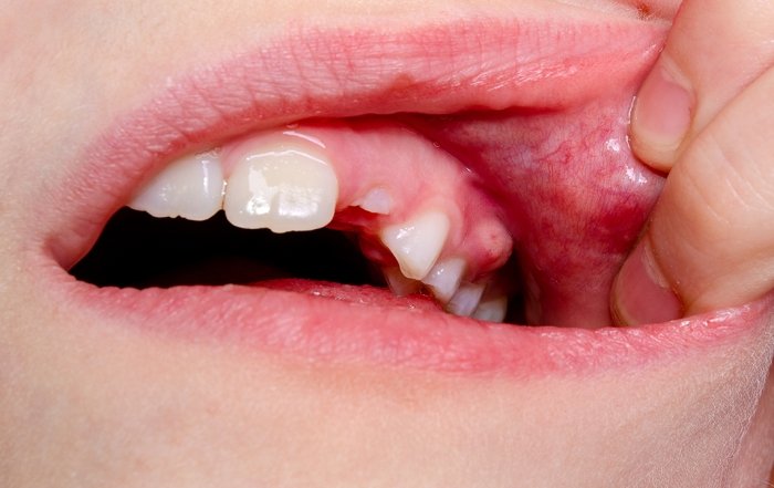 Pus Tooth