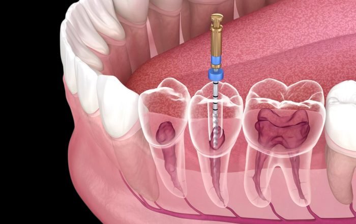 Root canal treatment
