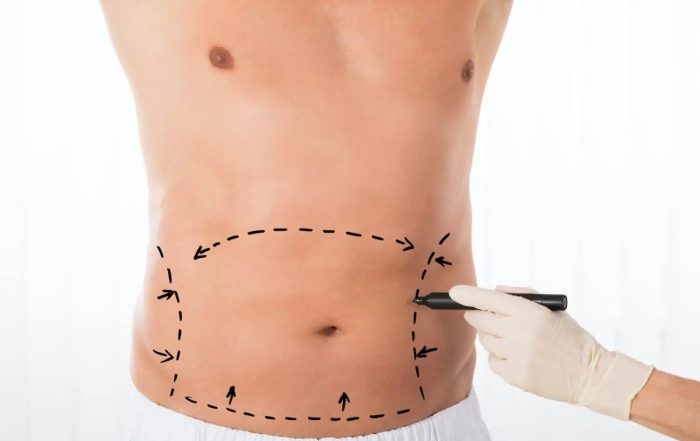 Smartlipo