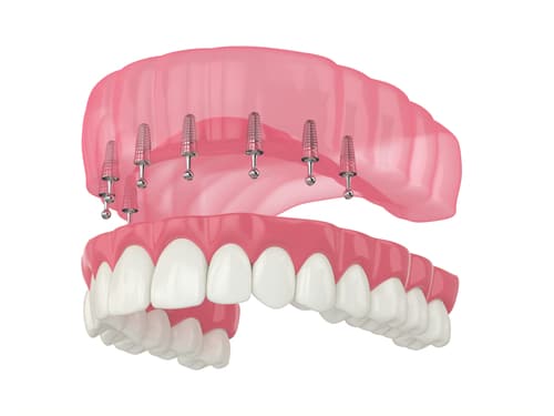 Snap on Dentures