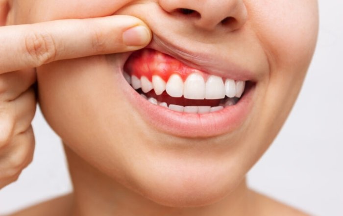 Swollen Gums