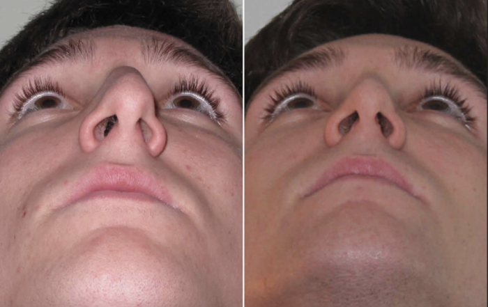 Symptoms of a Deviated Septum