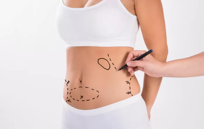 body contouring chirurgie