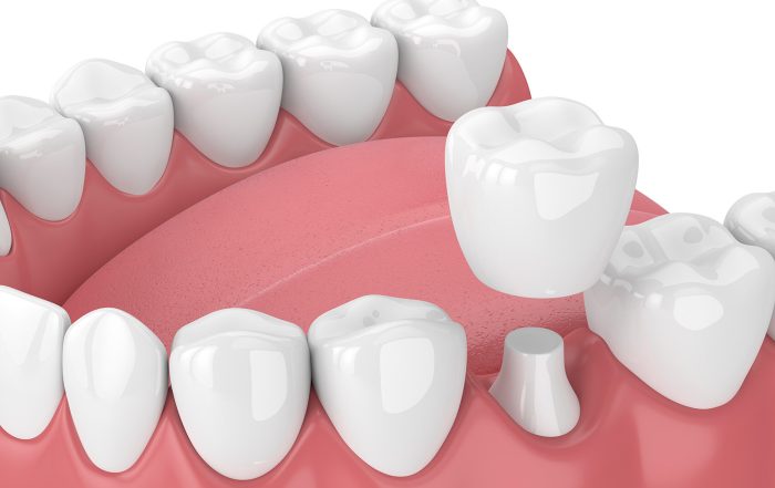 3d render of jaw with teeth and dental crown restoration