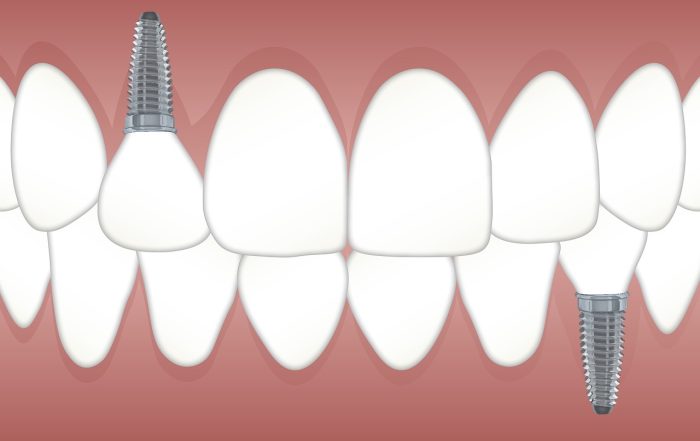 dental implants smile makeover