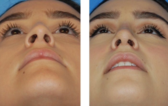 deviated septum self test