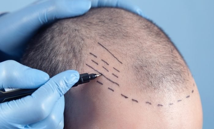 dhi hair transplant cost