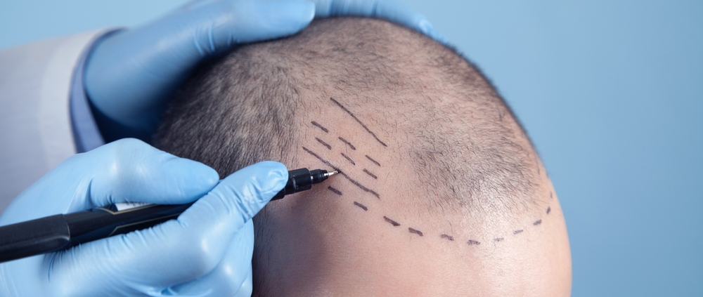 dhi hair transplant cost