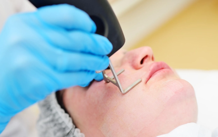 fractional co2 laser