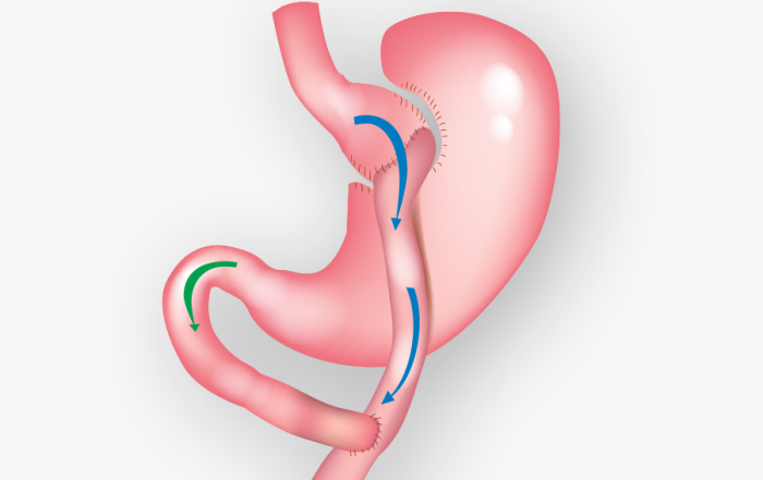 gastric bypass