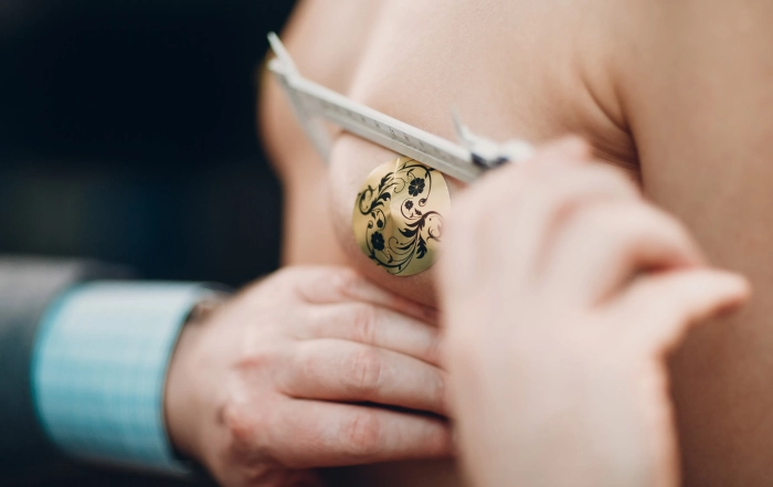 gynecomastia surgery