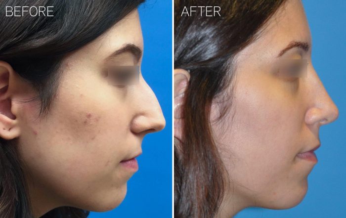 Rhinoplasty, Nose Job