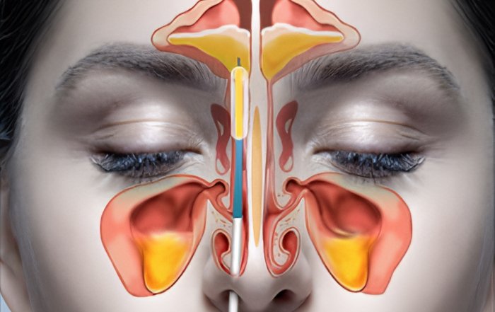 sinus surgery