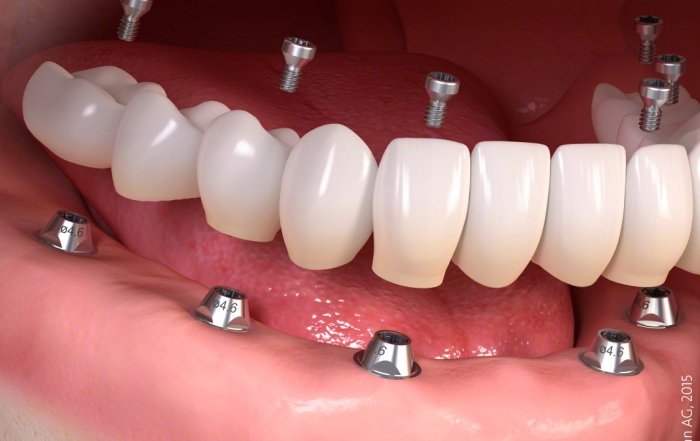 straumann implant