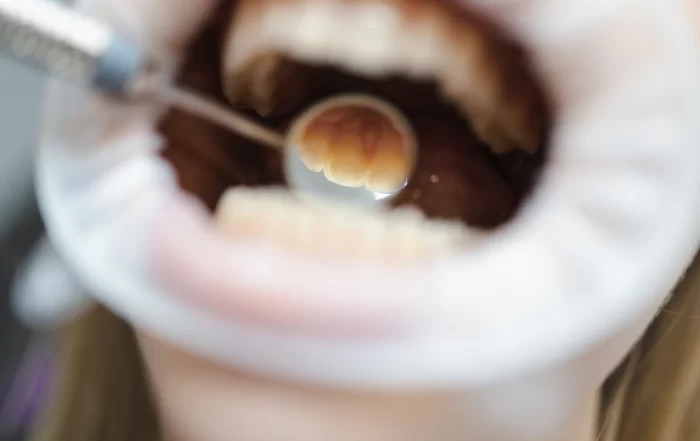 tartar teeth