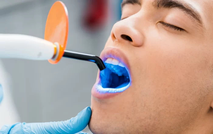 teeth bleaching