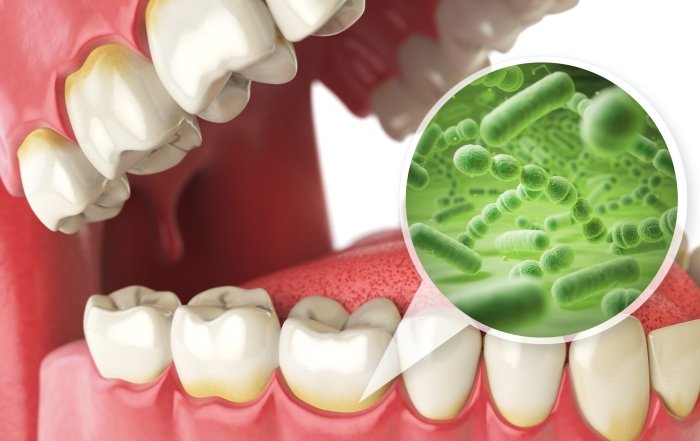 tooth infection