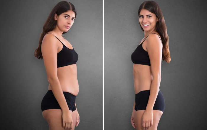 vaser lipo
