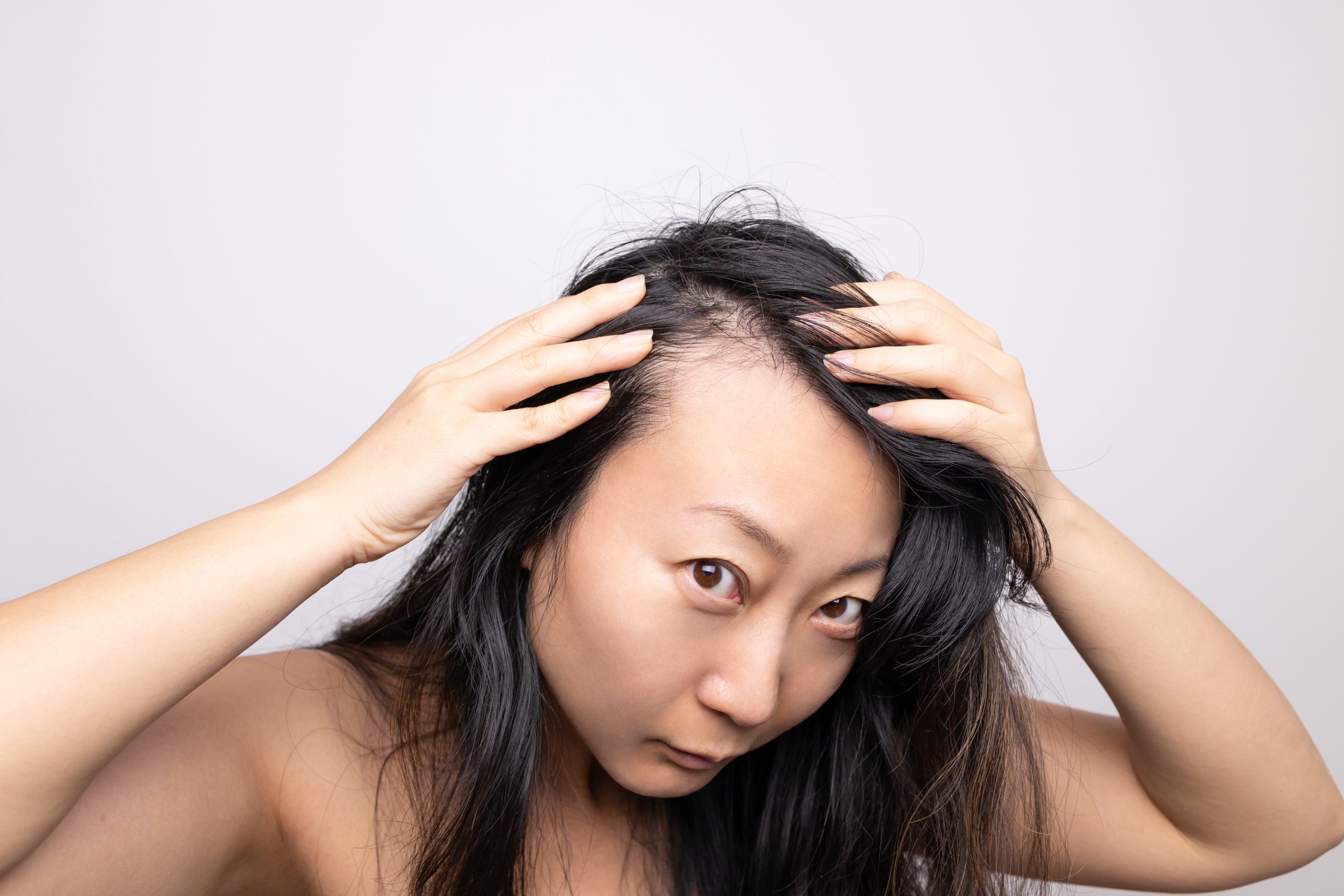 asian woman serious hair loss problem for health c 2023 02 02 01 22 31 utc