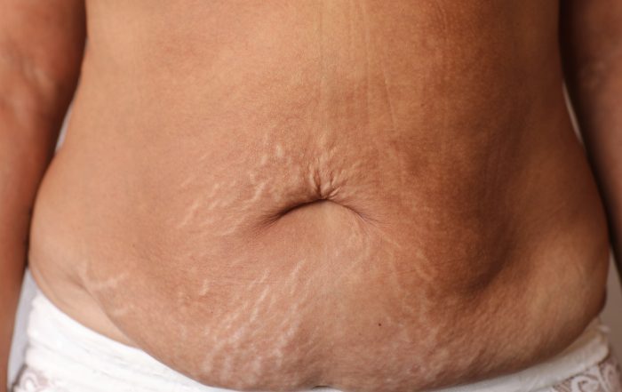 Close up of woman's belly with stretch mark loose lower abdomen skin she fat after pregnancy baby birth, studio isolated, unhealthy belly overweight excess body concept.