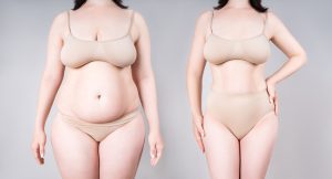 Allurion Balloon, gastric balloon, weight loss