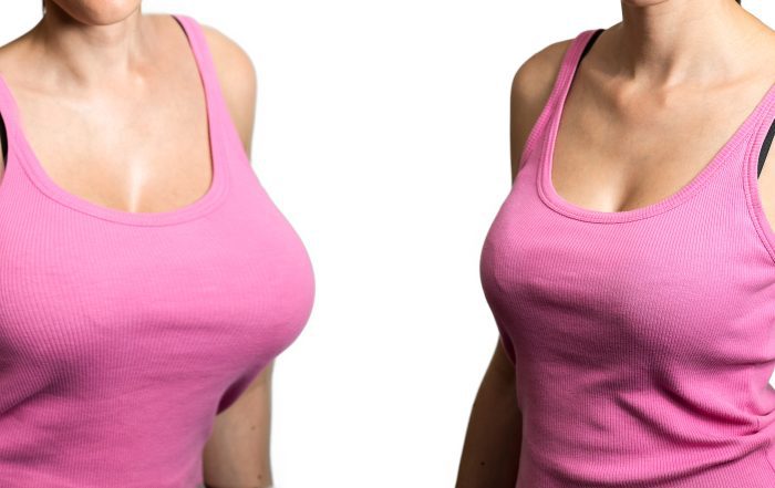 Before and after breast reduction surgery