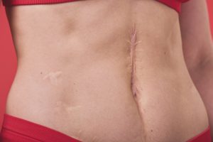 Female slim belly with scar