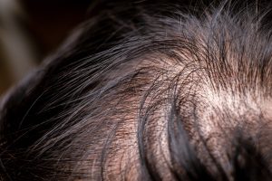 men adult hair loss . close up