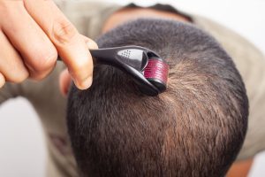 microneedling hair loss treatment for bald scalp to regrow hair