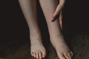 Female legs affected by edema or lymphedema condition