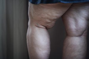 Fat woman with cellulite on her legs, cut out.