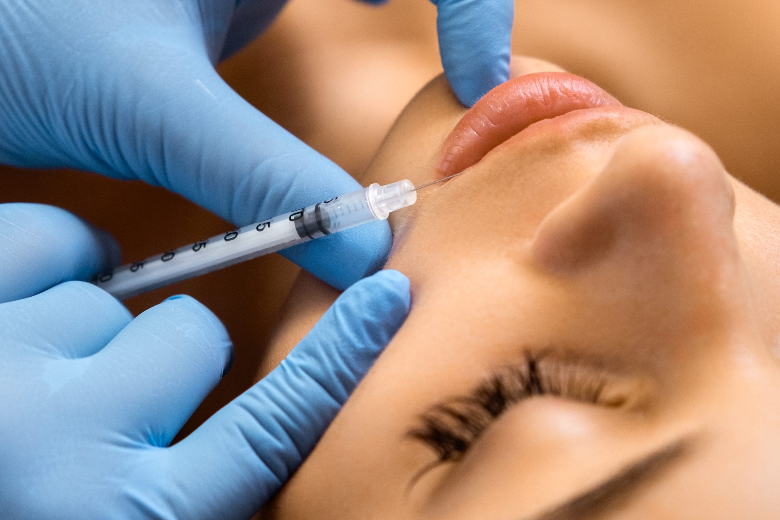 Lip augmentation procedure with hyaluronic acid in a beauty salon