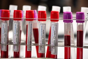 A row of human blood samples in a medical laboratory ready to be tested. healthcare background