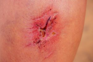 Close up of cyanotic keloid scar caused by surgery and suturing, skin imperfections or defects. dermatology and cosmetology