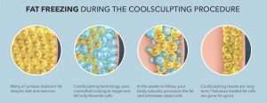 Coolsculpting, fat removal, weight loss