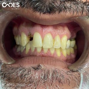 Mohammed, Cades Clinic, Dentall Treatment, Hollywood Smile, Smile Makeover, Istanbul