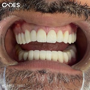 Mohammed, Cades Clinic, Dentall Treatment, Hollywood Smile, Smile Makeover, Istanbul