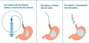 Allurion Balloon, gastric balloon, weight loss