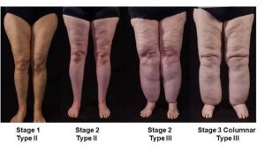 celebrities lipedema, liposuction